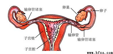 输卵管一边堵塞可以怀孕吗